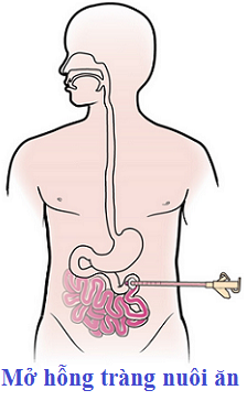 hình hỗng tràng nuôi ăn.png